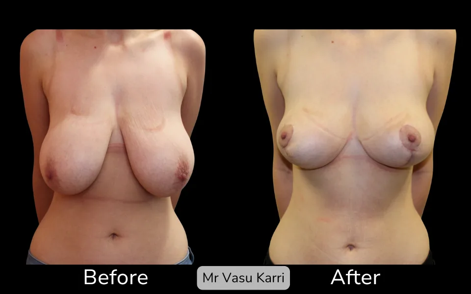 Before and after Breast Lift (Mastopexy), patient 2