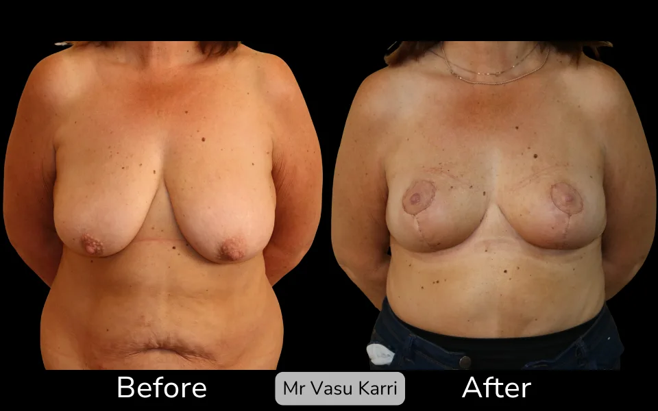 Before and after Breast Lift (Mastopexy), patient 3