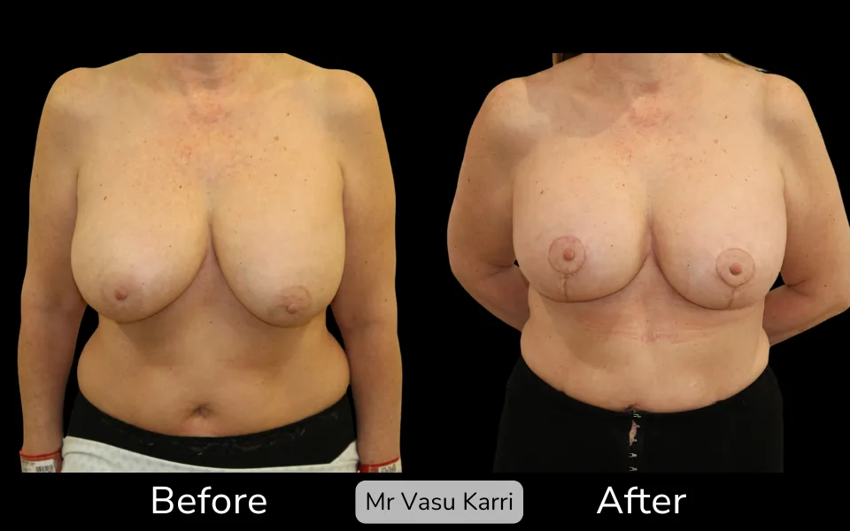 Before and after Breast Lift (Mastopexy), patient 4