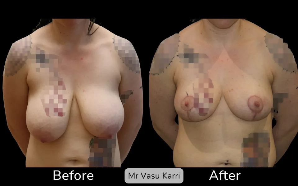Before and after Breast Lift (Mastopexy), patient 5