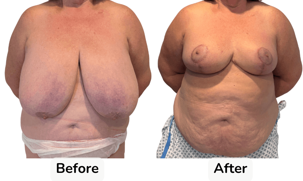 Breast Reduction Surgery in Rotherham Before & After 1