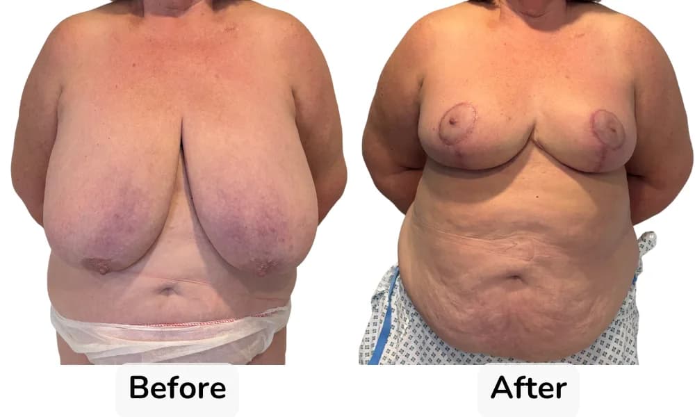 Before and after Breast Reduction, patient 0.9