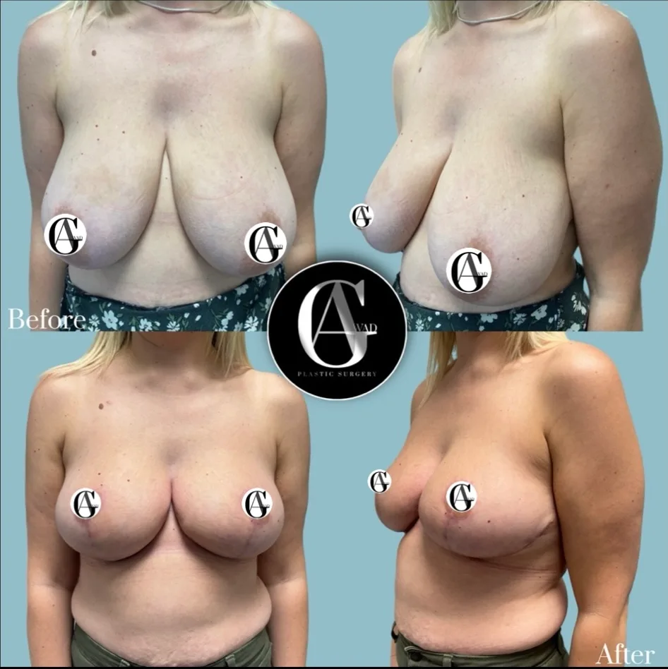 Before and after Breast Reduction, patient 1
