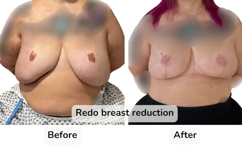 Before and after Breast Reduction, patient 10