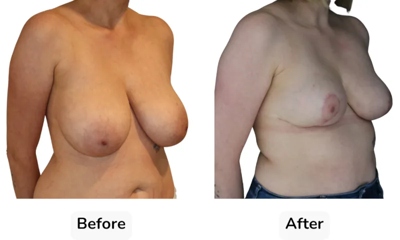 Before and after Breast Reduction, patient 11