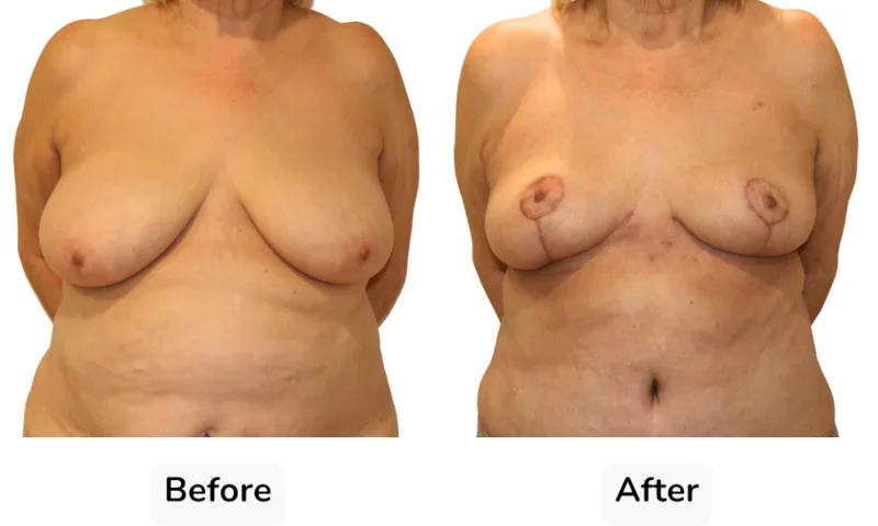 Before and after Breast Reduction, patient 12