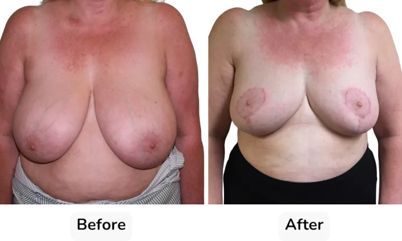 Before and after Breast Reduction, patient 13