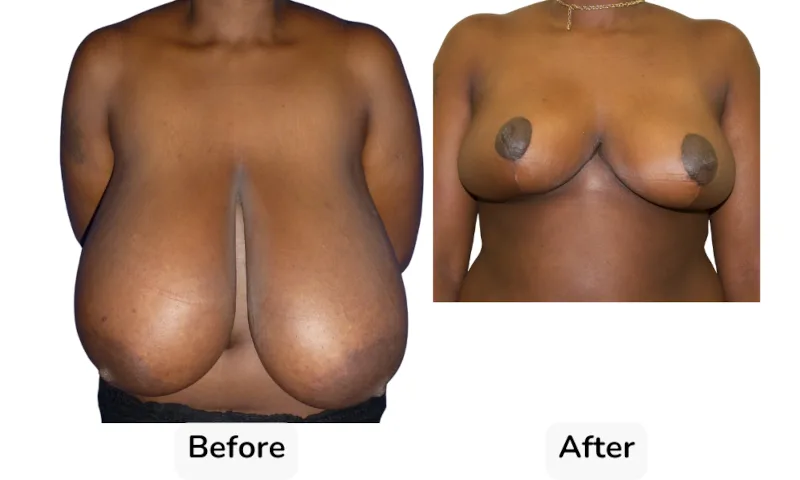 Before and after Breast Reduction, patient 14