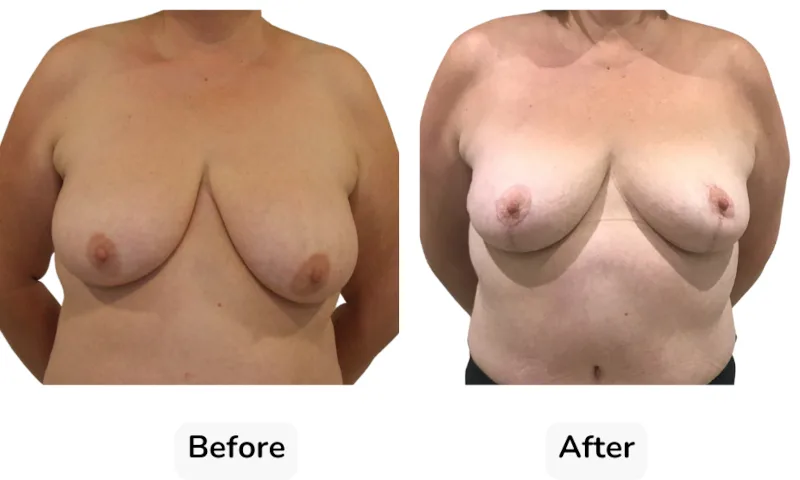 Before and after Breast Reduction, patient 15