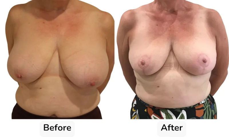 Before and after Breast Reduction, patient 16