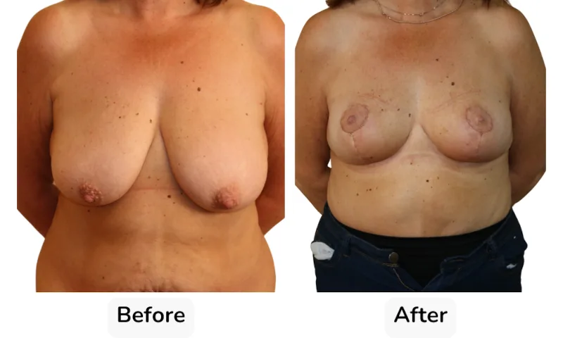 Before and after Breast Reduction, patient 17