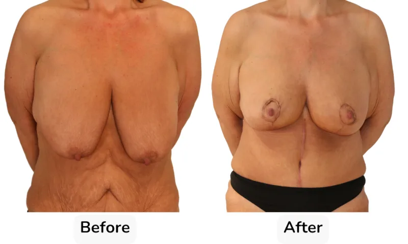 Before and after Breast Reduction, patient 18