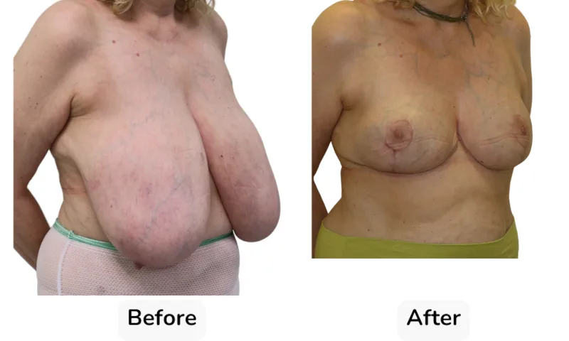 Before and after Breast Reduction, patient 19