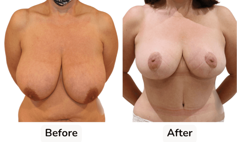 Breast Reduction Surgery in Rotherham Before & After 3