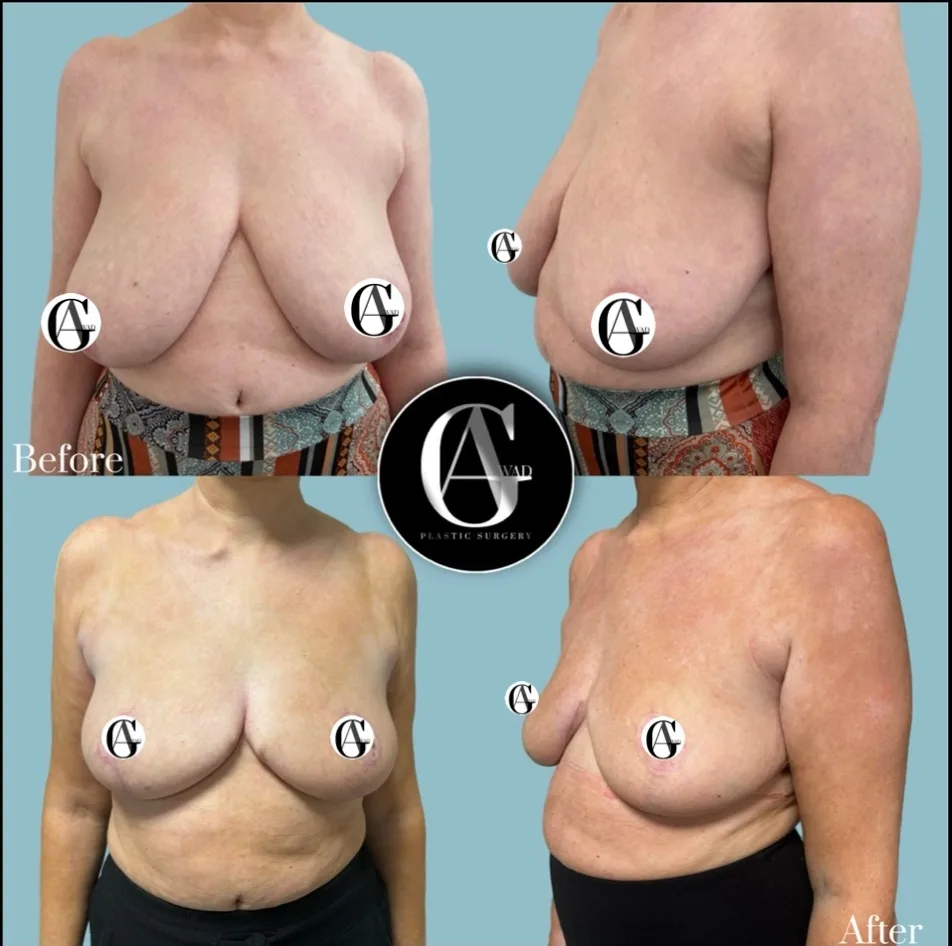 Before and after Breast Reduction, patient 2