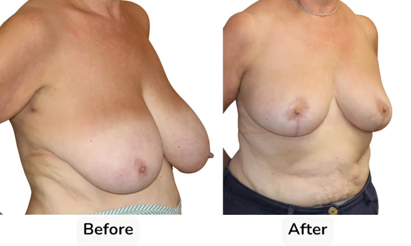 Before and after Breast Reduction, patient 20