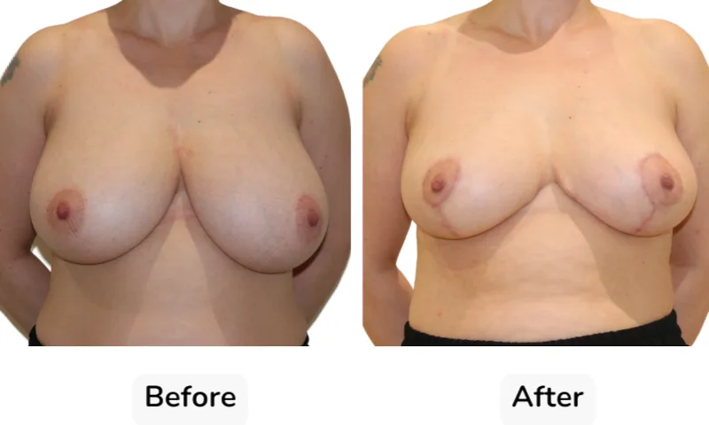 Before and after Breast Reduction, patient 3