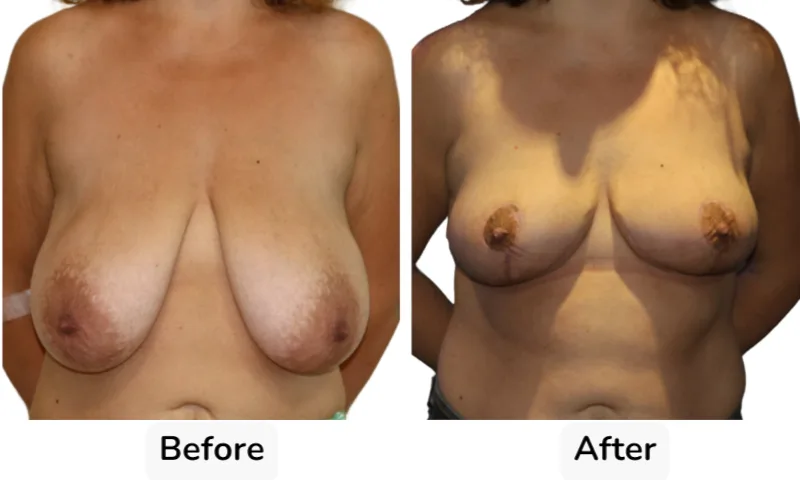 Before and after Breast Reduction, patient 4