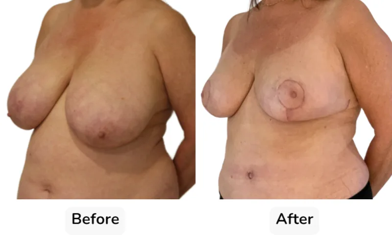 Before and after Breast Reduction, patient 5