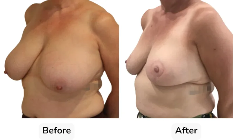 Before and after Breast Reduction, patient 6
