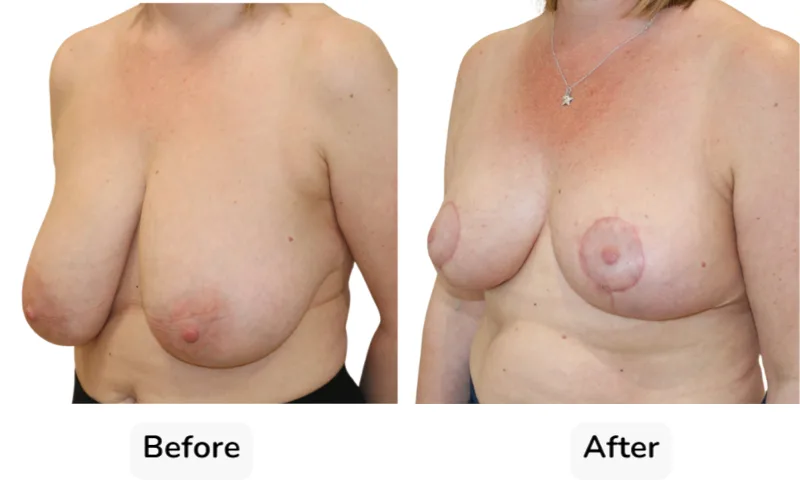 Before and after Breast Reduction, patient 7