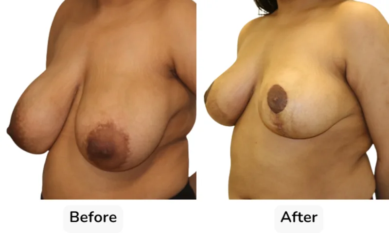 Before and after Breast Reduction, patient 8