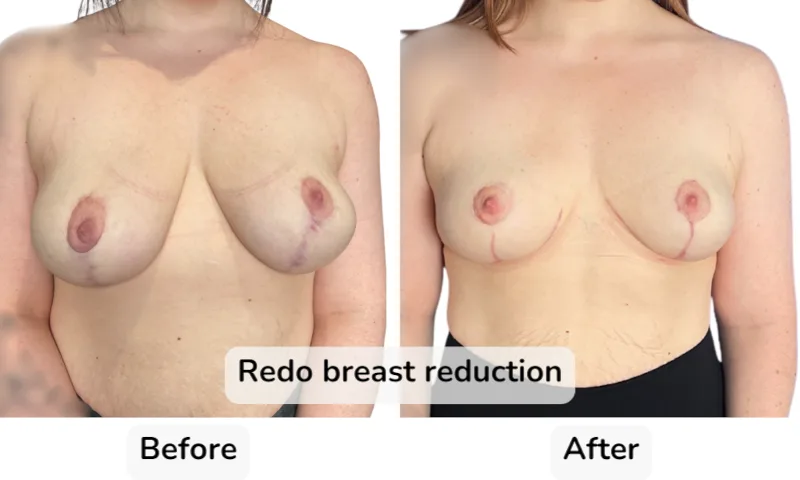 Before and after Breast Reduction, patient 9