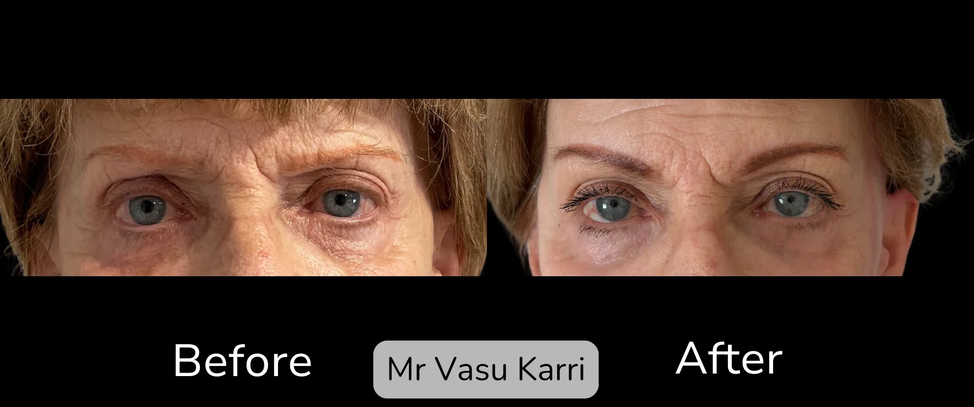 Before and after Brow Lift, patient 1