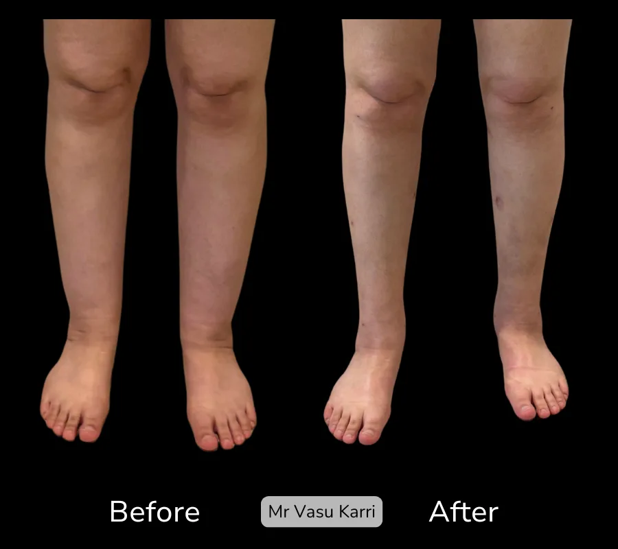 Before and after Cankle Surgery, patient 0.8