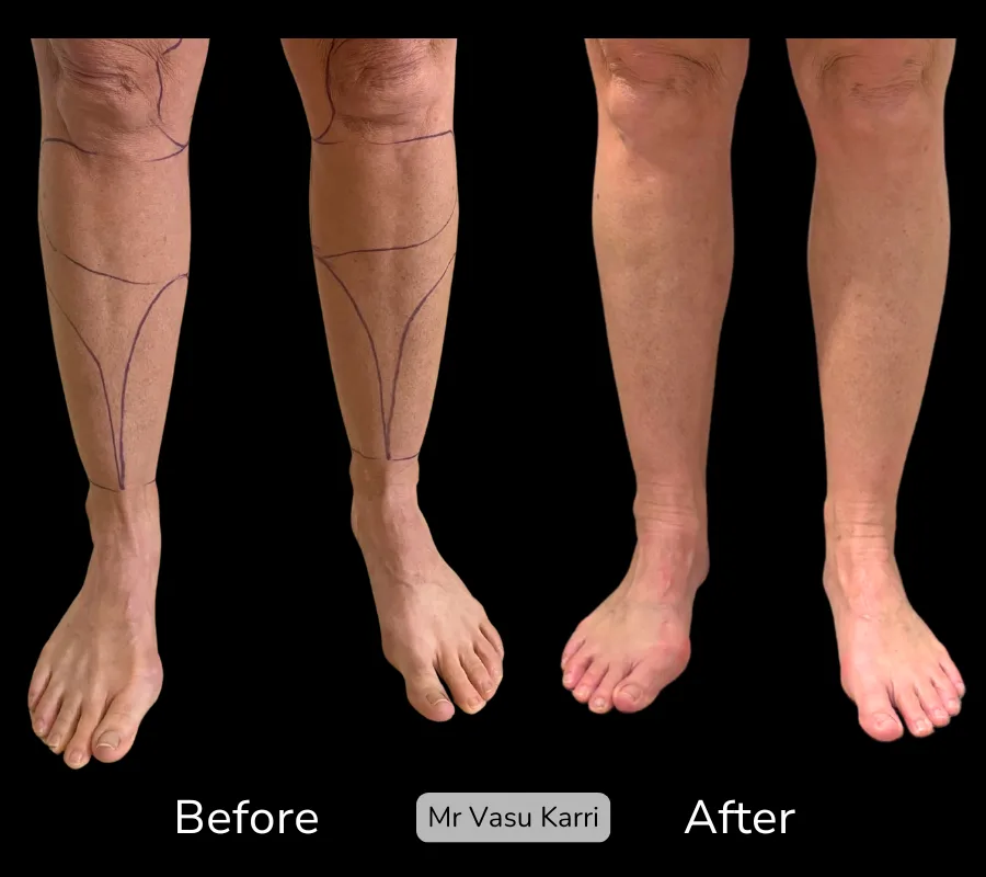 Before and after Cankle Surgery, patient 1
