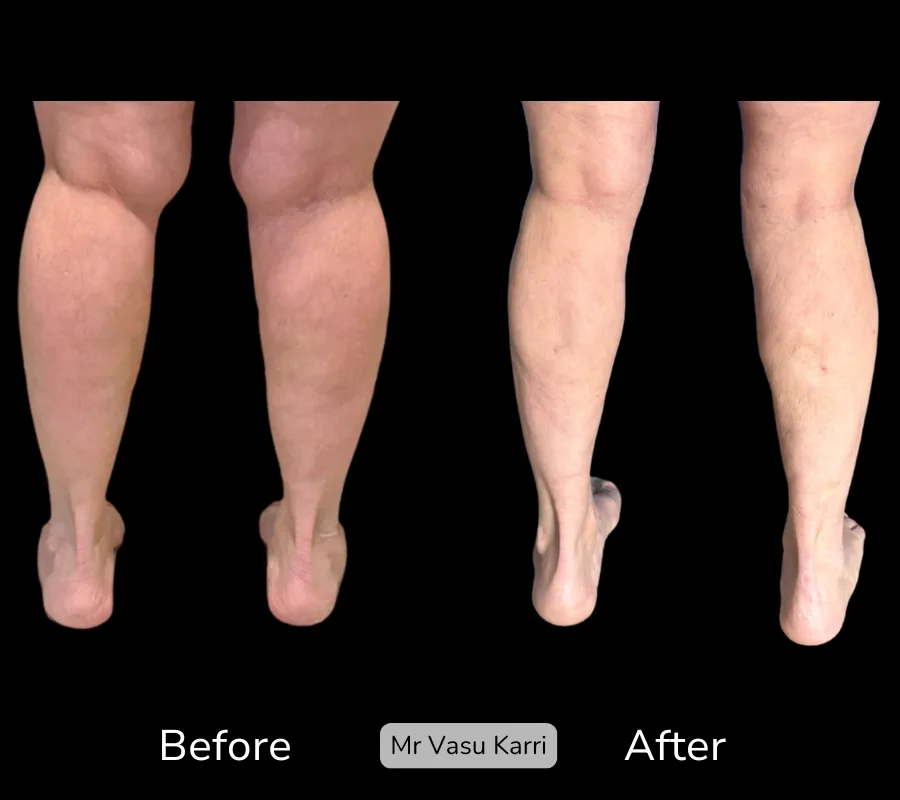 Before and after Cankle Surgery, patient 10