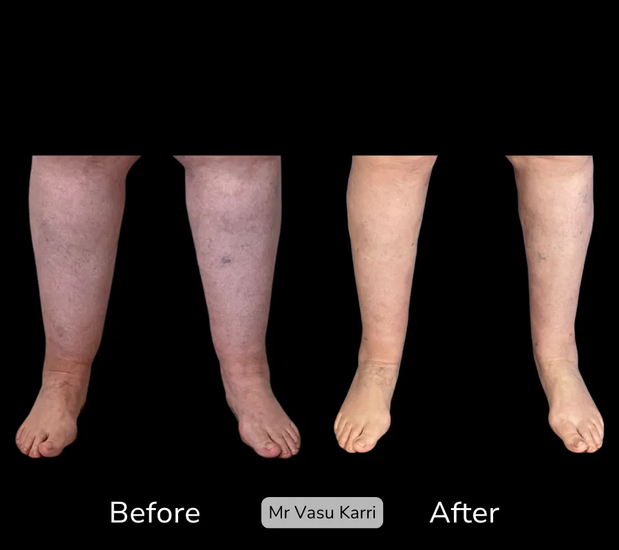 Before and after Cankle Surgery, patient 11