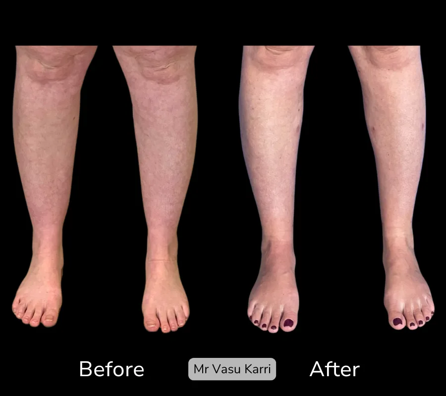 Before and after Cankle Surgery, patient 12
