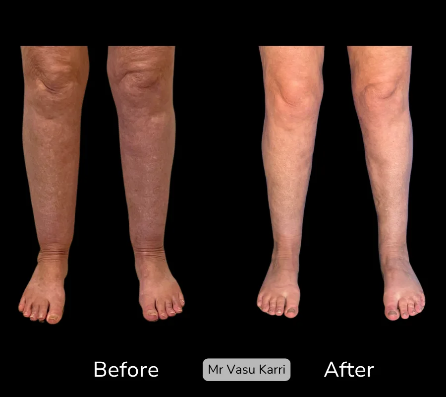 Before and after Cankle Surgery, patient 13