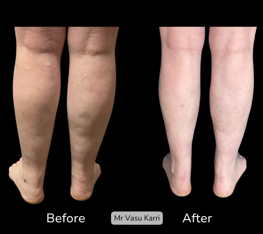 Before and after Cankle Surgery, patient 14