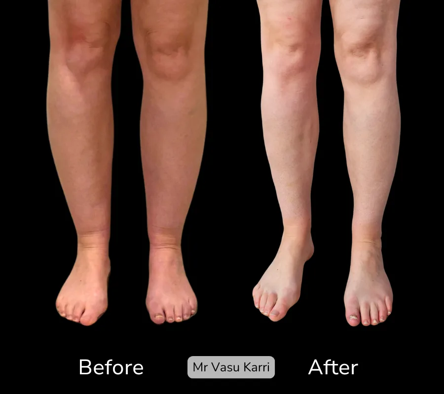 Before and after Cankle Surgery, patient 15
