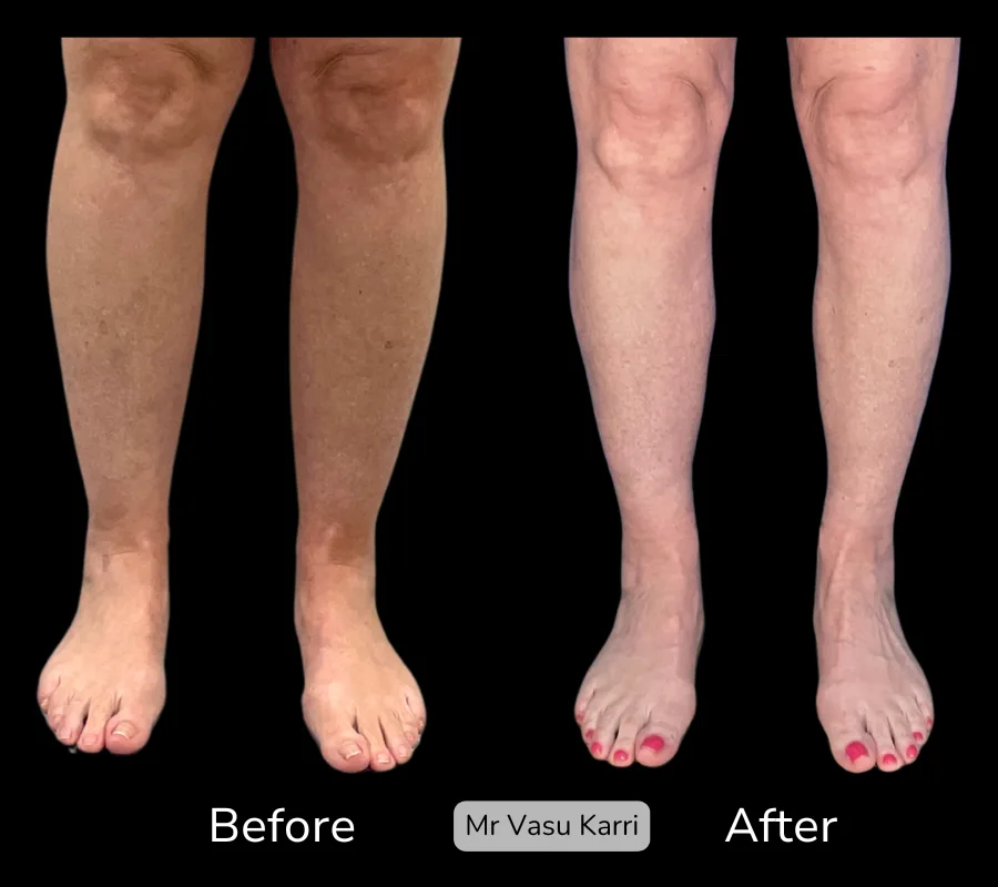 Before and after Cankle Surgery, patient 16
