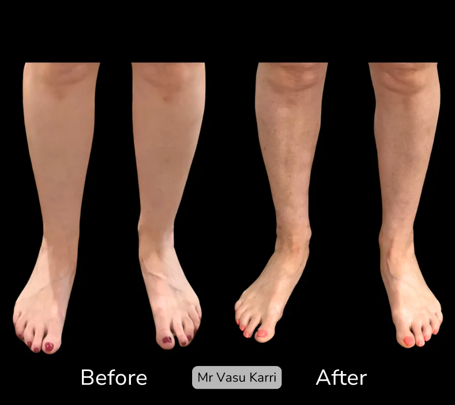 Before and after Cankle Surgery, patient 17