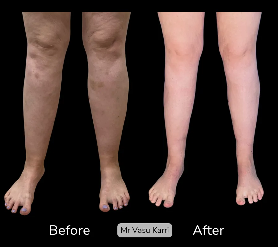 Before and after Cankle Surgery, patient 18