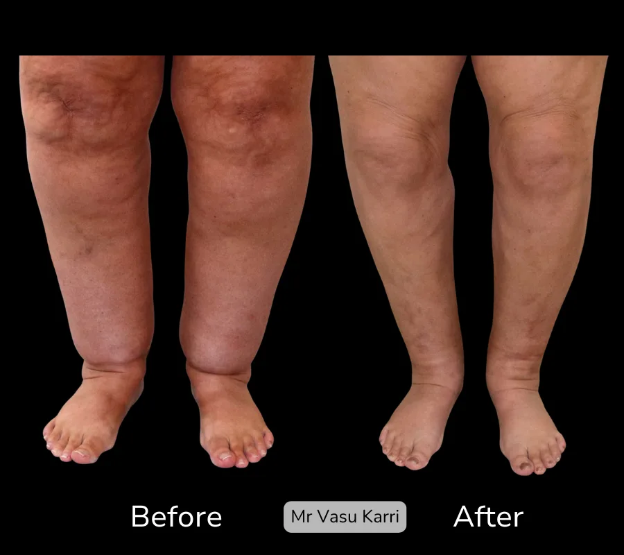 Before and after Cankle Surgery, patient 19
