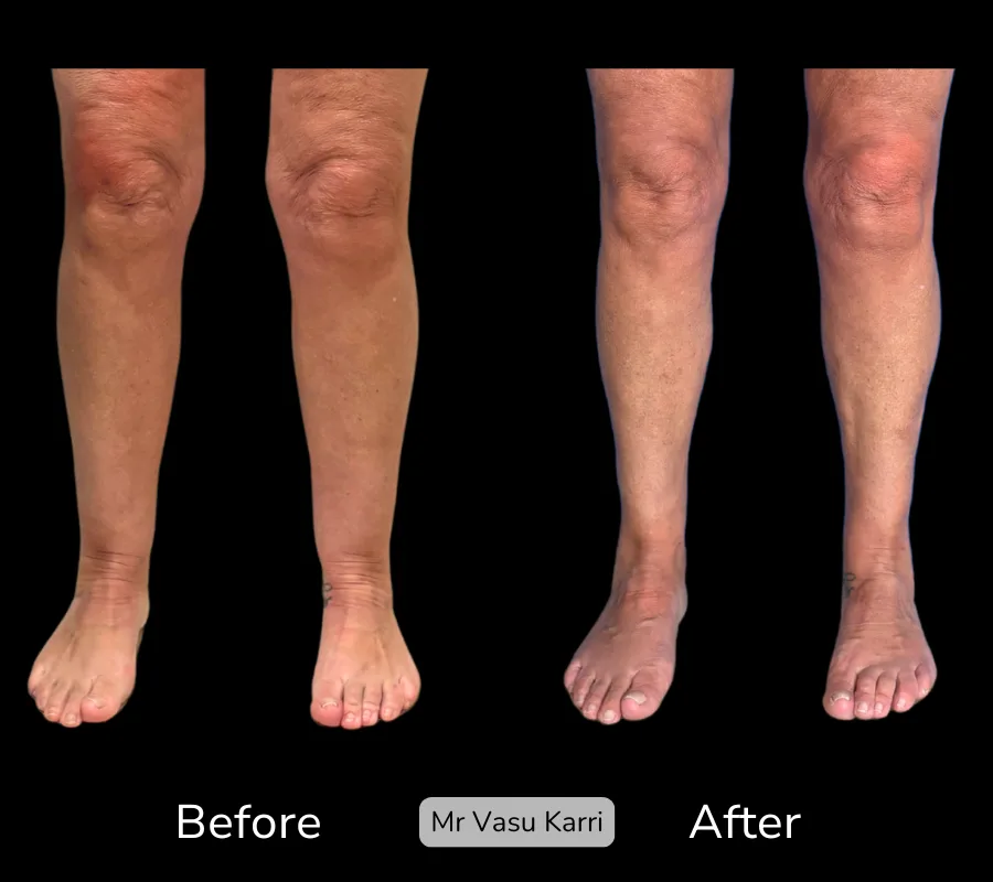Before and after Cankle Surgery, patient 2