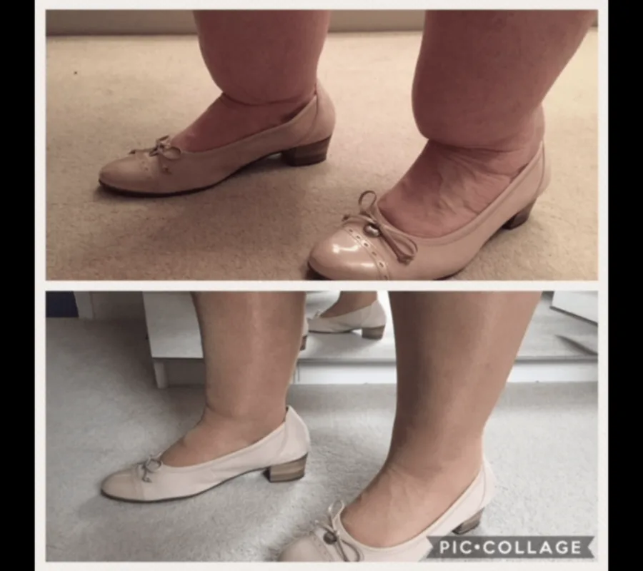 Before and after Cankle Surgery, patient 20