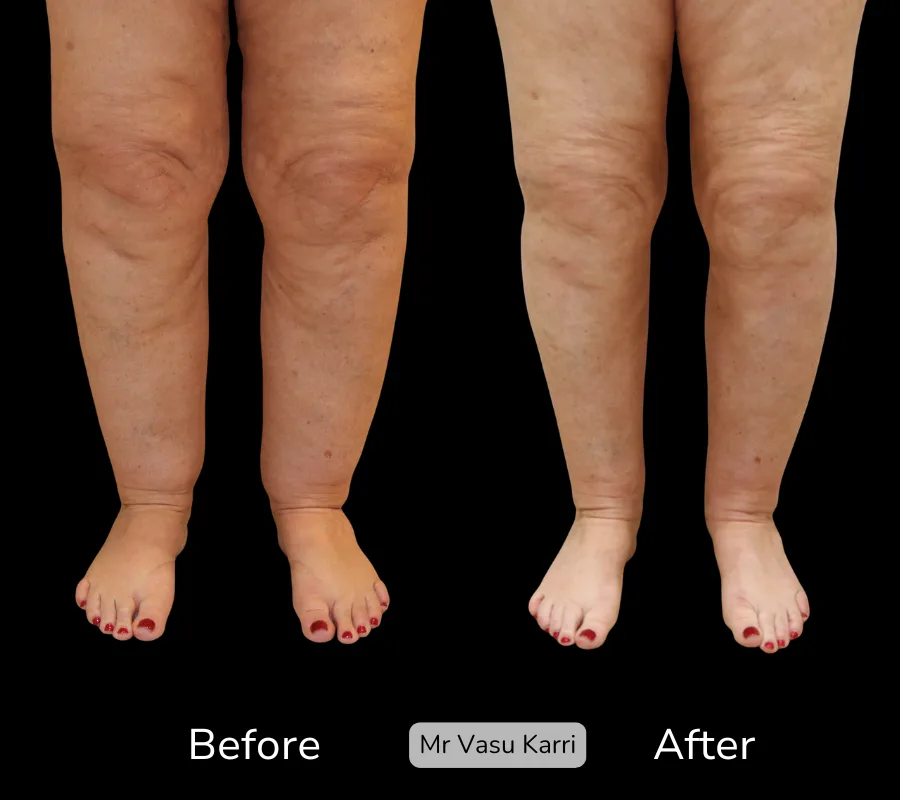 Before and after Cankle Surgery, patient 21