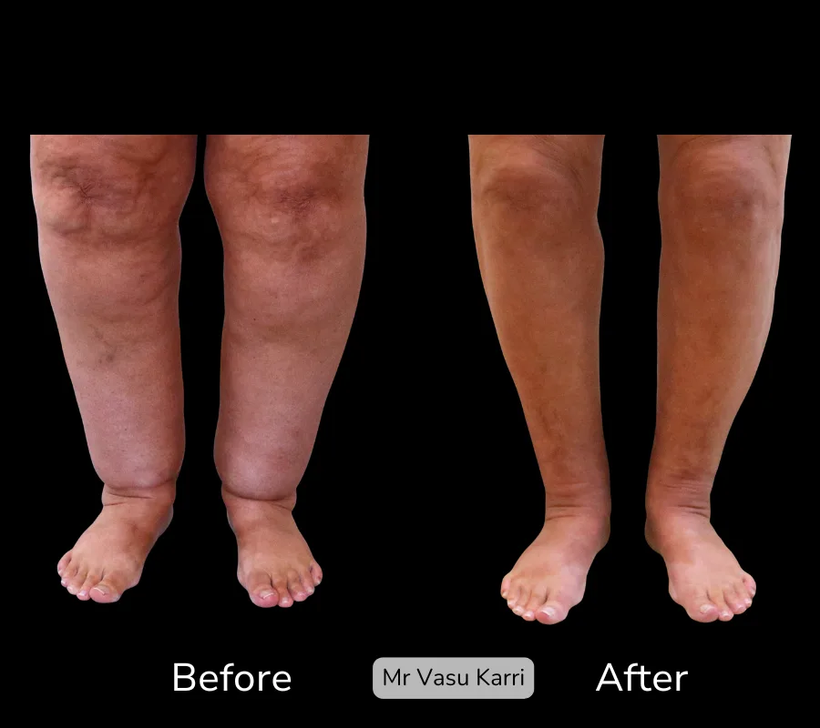 Before and after Cankle Surgery, patient 22