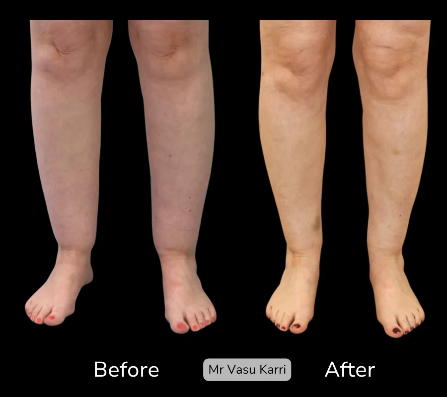 Before and after Cankle Surgery, patient 23