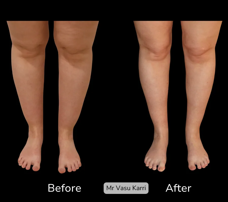 Before and after Cankle Surgery, patient 24