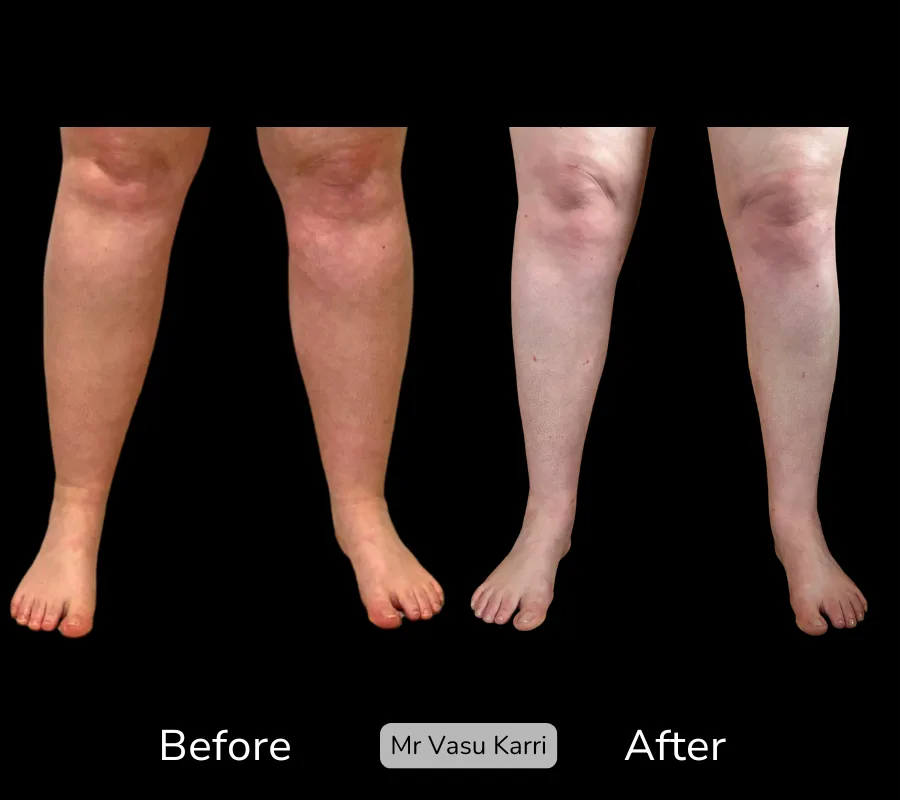 Before and after Cankle Surgery, patient 25