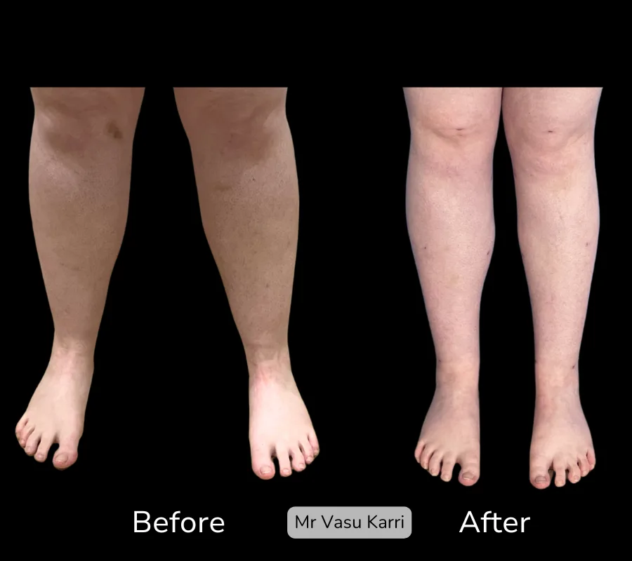 Before and after Cankle Surgery, patient 26