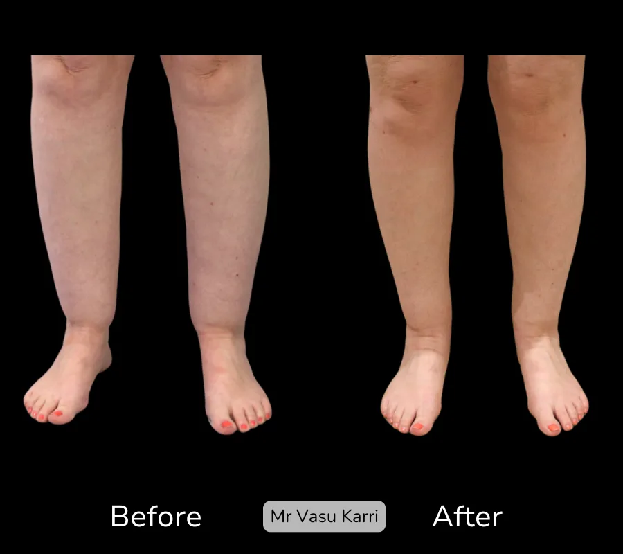 Before and after Cankle Surgery, patient 27