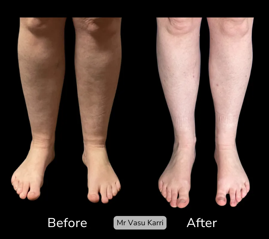 Before and after Cankle Surgery, patient 4